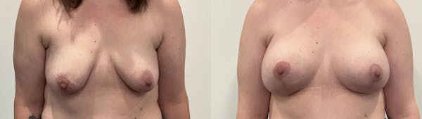 Breast Augmentation Before & After Gallery - Patient 280696 - Image 1