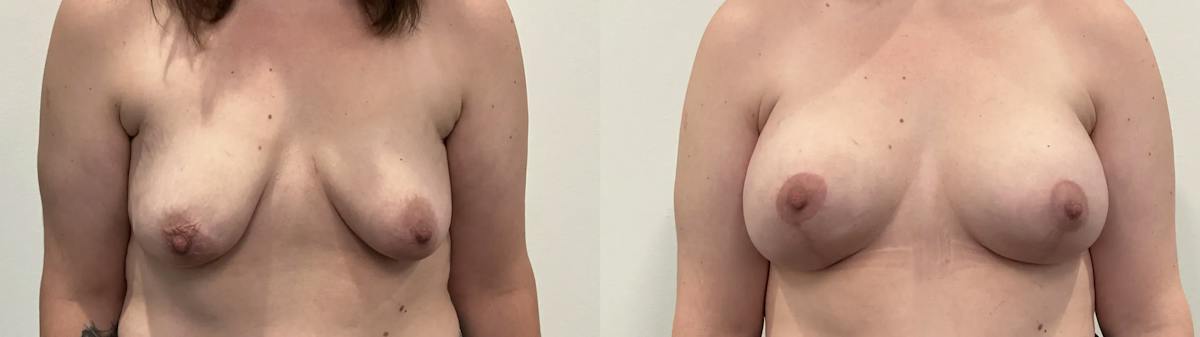 Breast Augmentation Before & After Gallery - Patient 280696 - Image 1