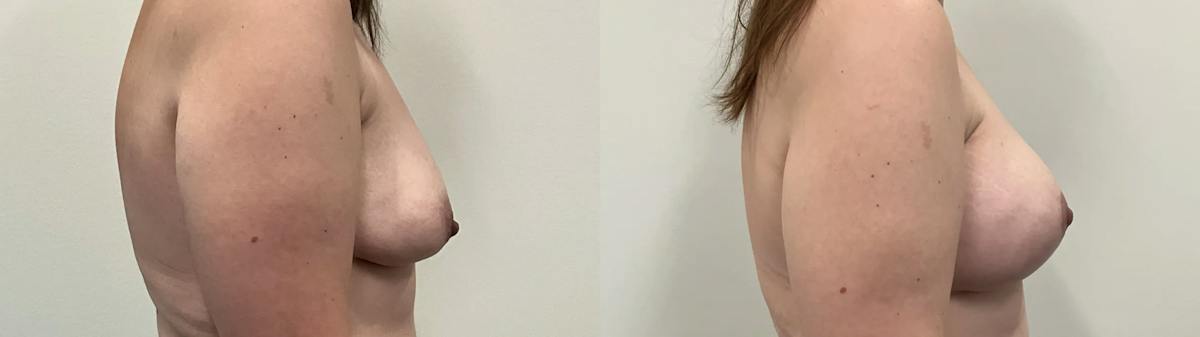 Breast Augmentation Before & After Gallery - Patient 280696 - Image 2