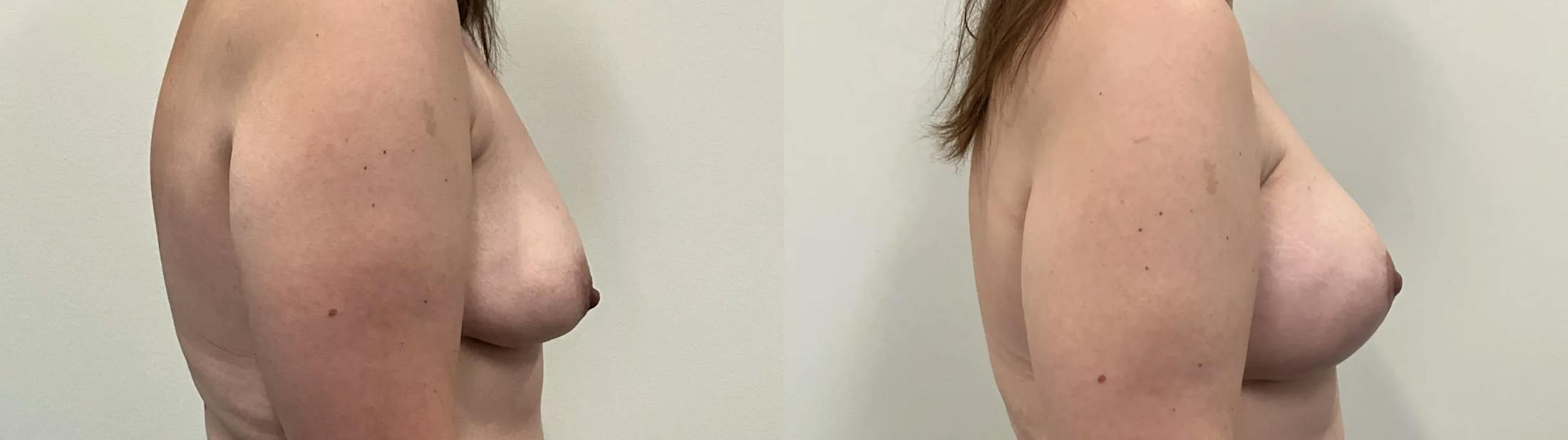 Breast Augmentation Before & After Gallery - Patient 280696 - Image 2