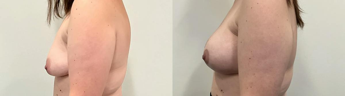 Breast Augmentation Before & After Gallery - Patient 280696 - Image 3