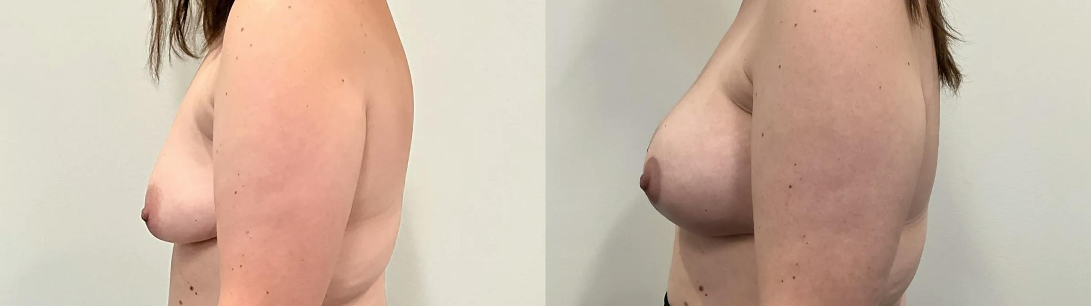 Breast Augmentation Before & After Gallery - Patient 280696 - Image 3