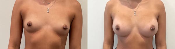 Breast Augmentation Before & After Gallery - Patient 401056 - Image 1