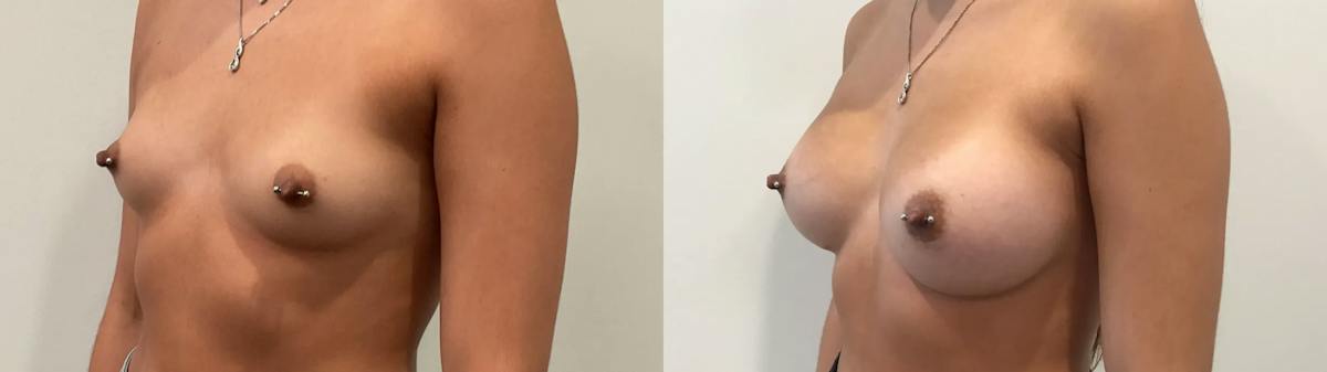 Breast Augmentation Before & After Gallery - Patient 401056 - Image 2
