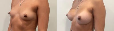 Breast Augmentation Before & After Gallery - Patient 401056 - Image 2