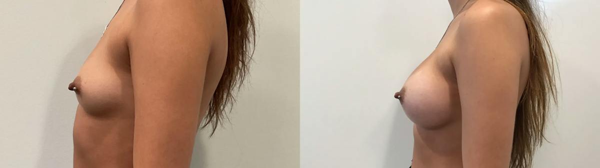 Breast Augmentation Before & After Gallery - Patient 401056 - Image 3