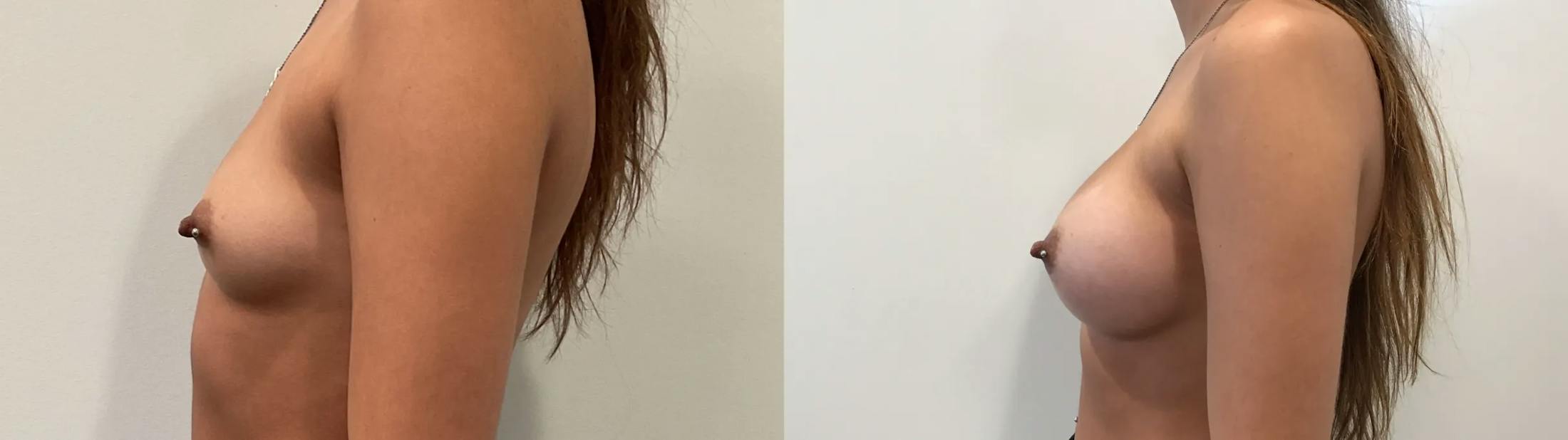 Breast Augmentation Before & After Gallery - Patient 401056 - Image 3