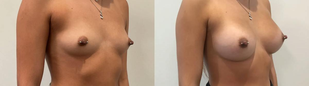 Breast Augmentation Before & After Gallery - Patient 401056 - Image 4