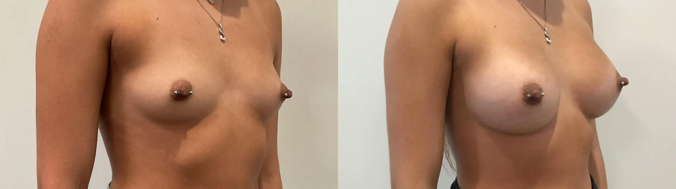 Breast Augmentation Before & After Gallery - Patient 401056 - Image 4