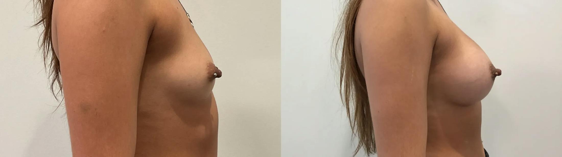 Breast Augmentation Before & After Gallery - Patient 401056 - Image 5