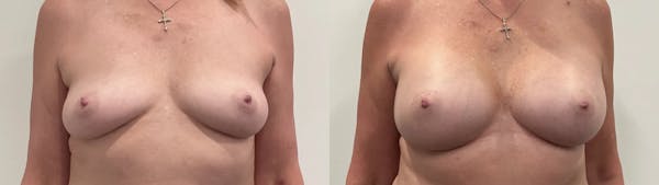 Breast Augmentation Before & After Gallery - Patient 420181 - Image 1