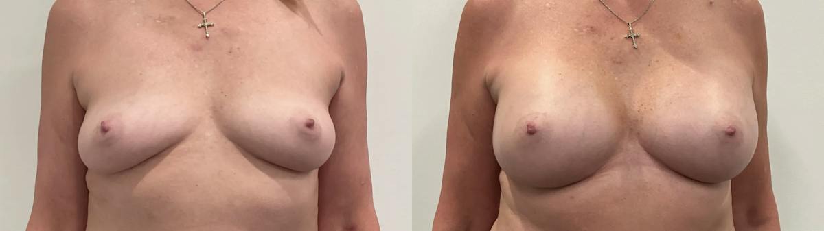 Breast Augmentation Before & After Gallery - Patient 420181 - Image 1