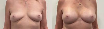 Breast Augmentation Before & After Gallery - Patient 420181 - Image 1