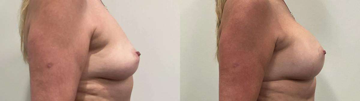 Breast Augmentation Before & After Gallery - Patient 420181 - Image 2