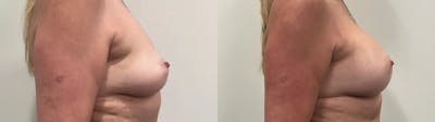 Breast Augmentation Before & After Gallery - Patient 420181 - Image 2