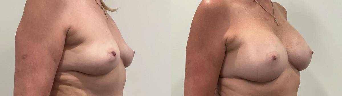 Breast Augmentation Before & After Gallery - Patient 420181 - Image 3