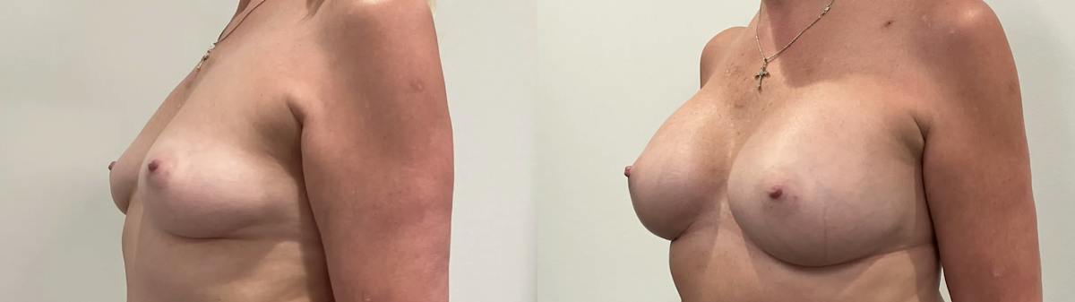 Breast Augmentation Before & After Gallery - Patient 420181 - Image 4