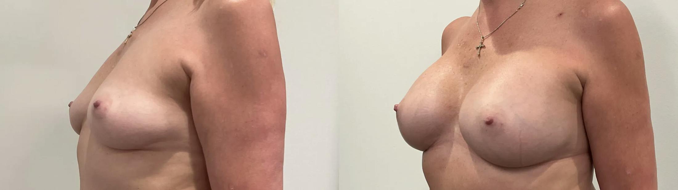 Breast Augmentation Before & After Gallery - Patient 420181 - Image 4