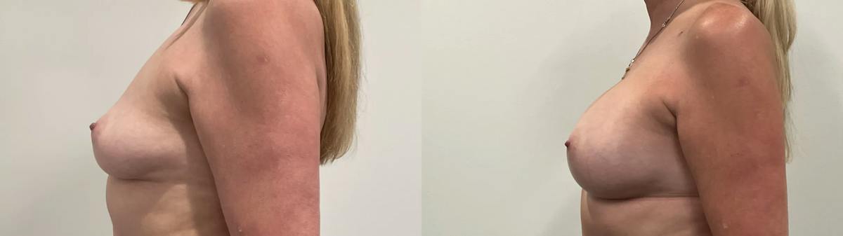 Breast Augmentation Before & After Gallery - Patient 420181 - Image 5