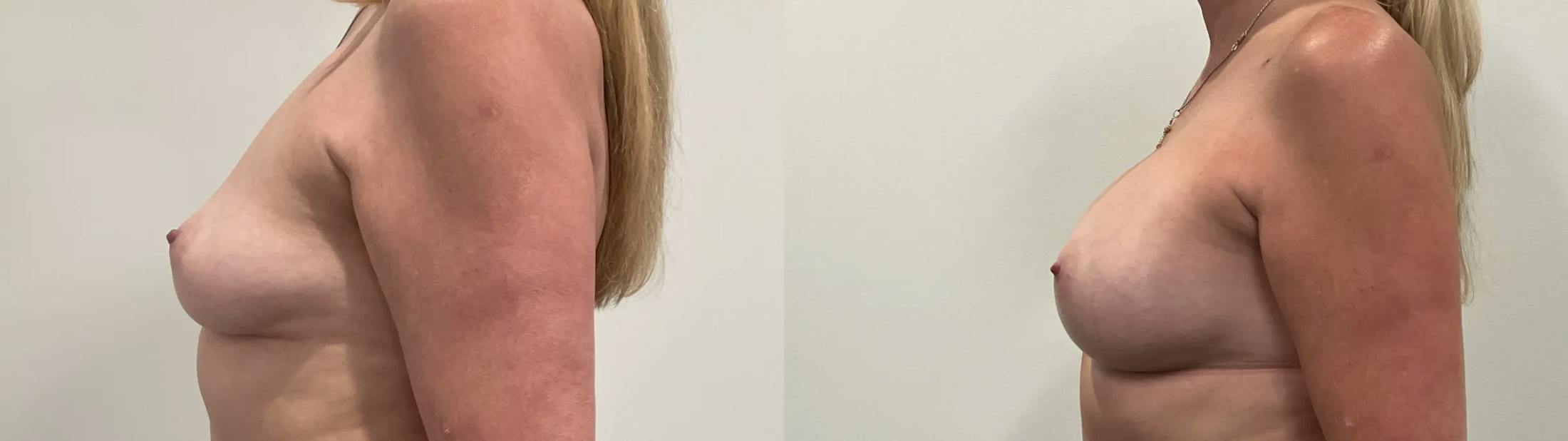 Breast Augmentation Before & After Gallery - Patient 420181 - Image 5