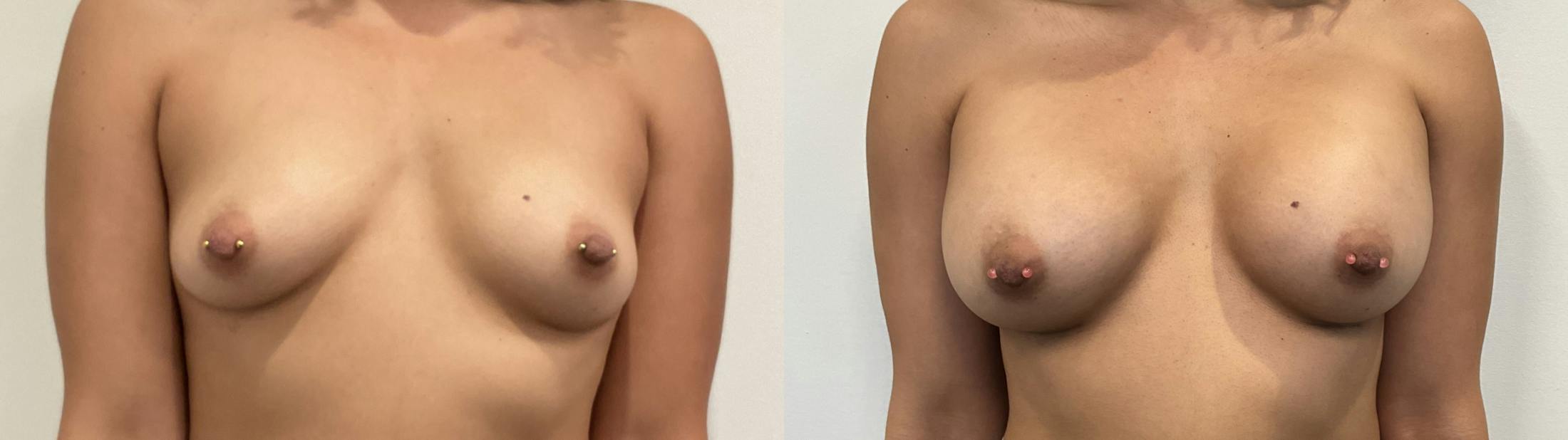 Breast Augmentation Before & After Gallery - Patient 180514 - Image 1