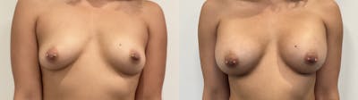 Breast Augmentation Before & After Gallery - Patient 180514 - Image 1