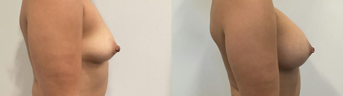 Breast Augmentation Before & After Gallery - Patient 180514 - Image 2