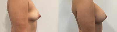 Breast Augmentation Before & After Gallery - Patient 180514 - Image 2