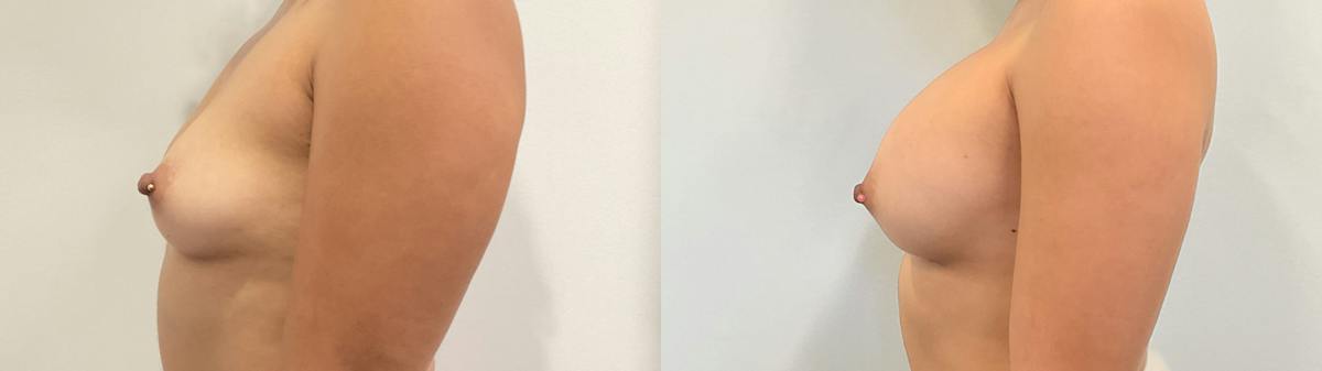 Breast Augmentation Before & After Gallery - Patient 180514 - Image 3