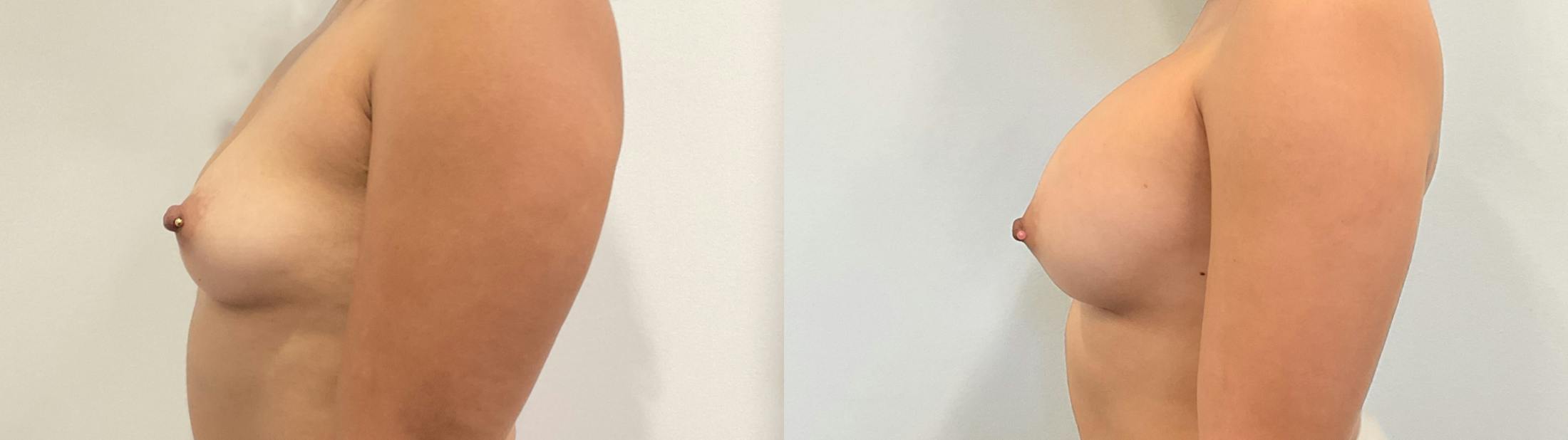 Breast Augmentation Before & After Gallery - Patient 180514 - Image 3