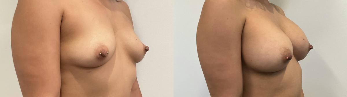 Breast Augmentation Before & After Gallery - Patient 180514 - Image 4
