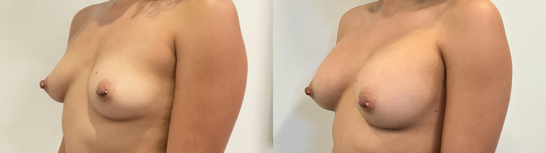 Breast Augmentation Before & After Gallery - Patient 180514 - Image 5