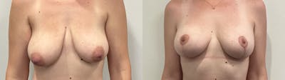 Breast Augmentation Before & After Gallery - Patient 200872 - Image 1