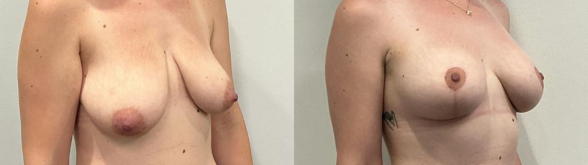 Breast Augmentation Before & After Gallery - Patient 200872 - Image 2