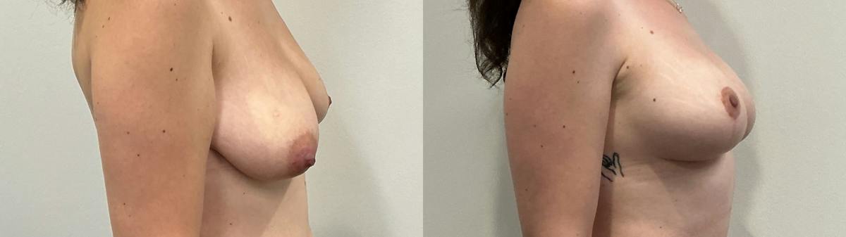 Breast Augmentation Before & After Gallery - Patient 200872 - Image 3