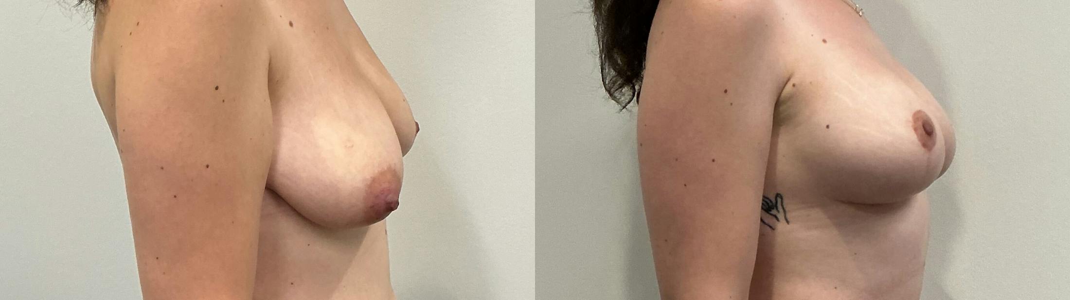 Breast Augmentation Before & After Gallery - Patient 200872 - Image 3