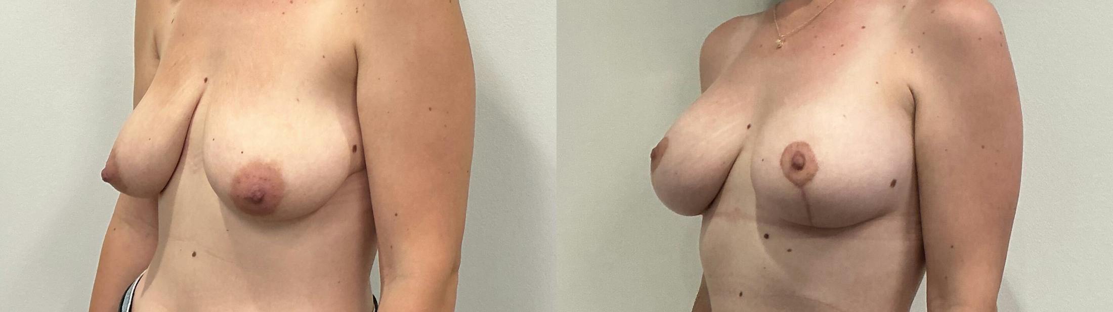 Breast Augmentation Before & After Gallery - Patient 200872 - Image 4