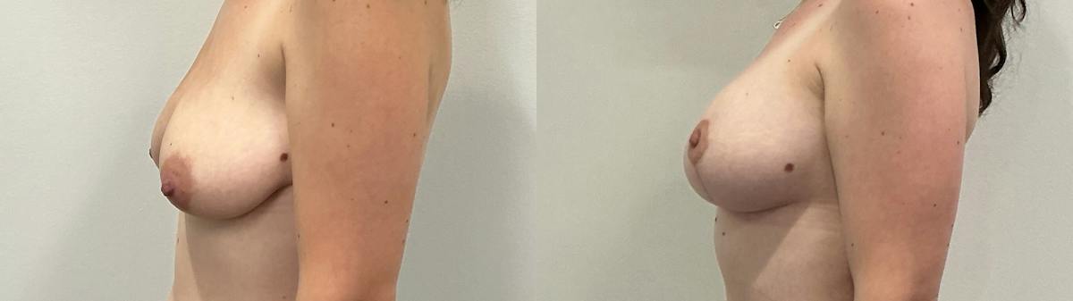 Breast Augmentation Before & After Gallery - Patient 200872 - Image 5