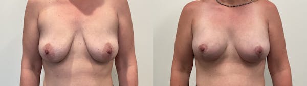 Breast Augmentation Before & After Gallery - Patient 298044 - Image 1