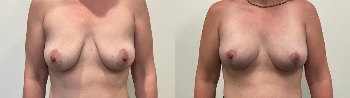 Breast Augmentation Before & After Gallery - Patient 298044 - Image 1