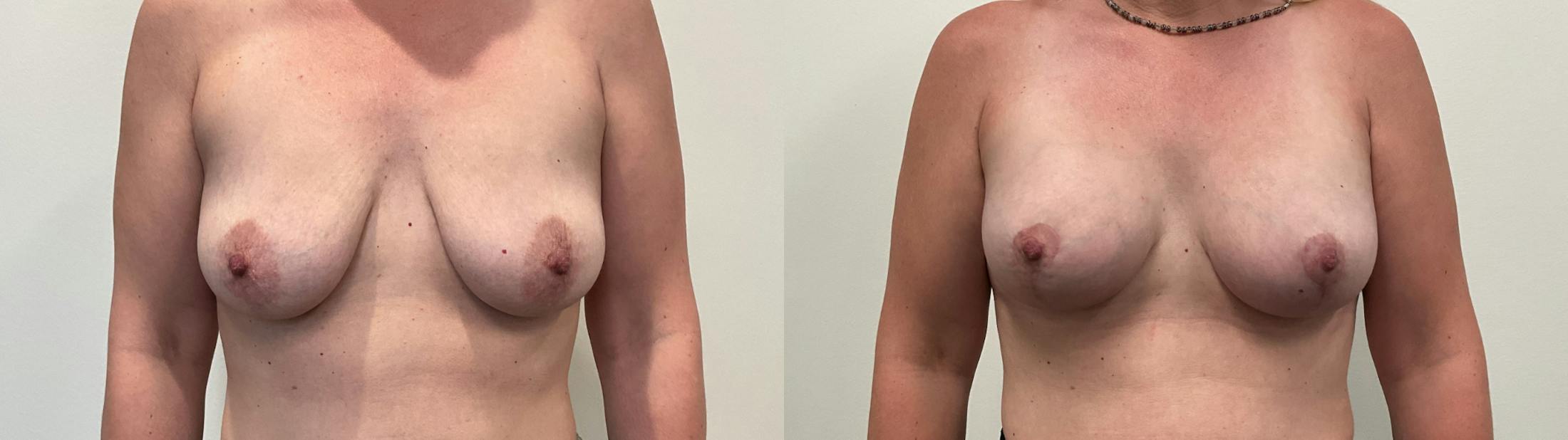 Breast Augmentation Before & After Gallery - Patient 298044 - Image 1