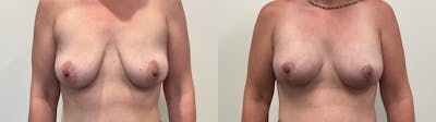 Breast Augmentation Before & After Gallery - Patient 298044 - Image 1