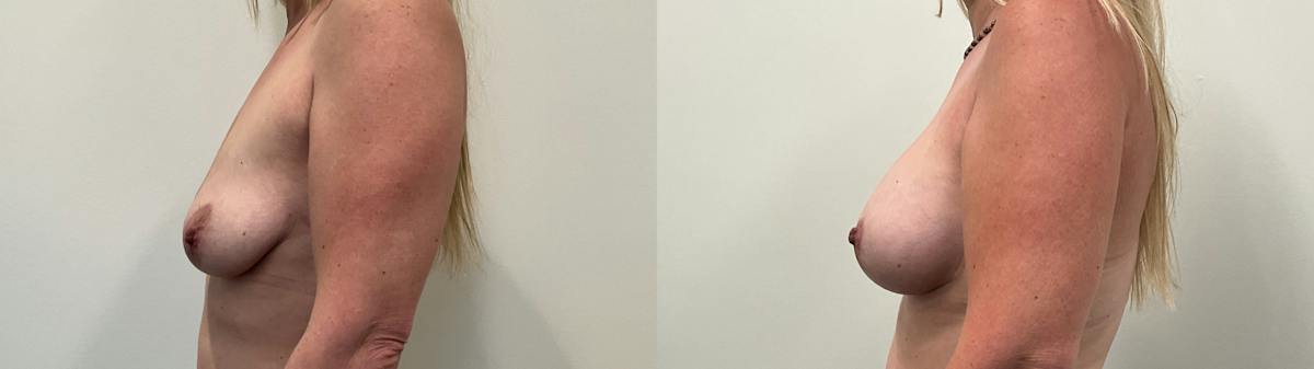Breast Augmentation Before & After Gallery - Patient 298044 - Image 2