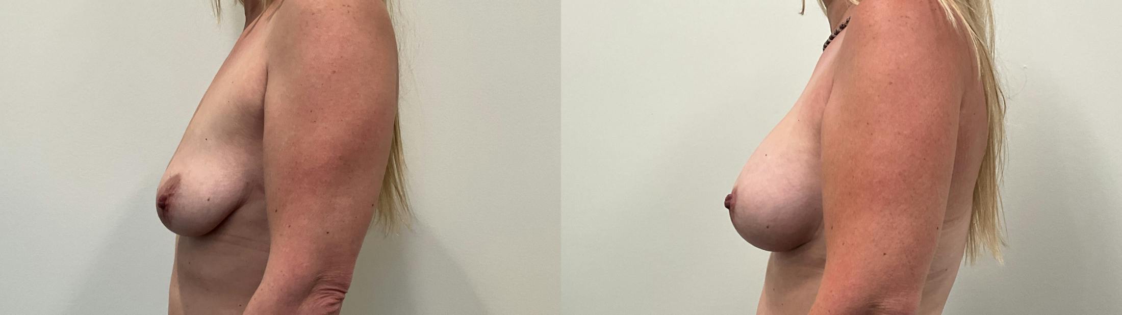 Breast Augmentation Before & After Gallery - Patient 298044 - Image 2