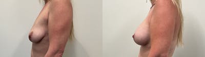Breast Augmentation Before & After Gallery - Patient 298044 - Image 2