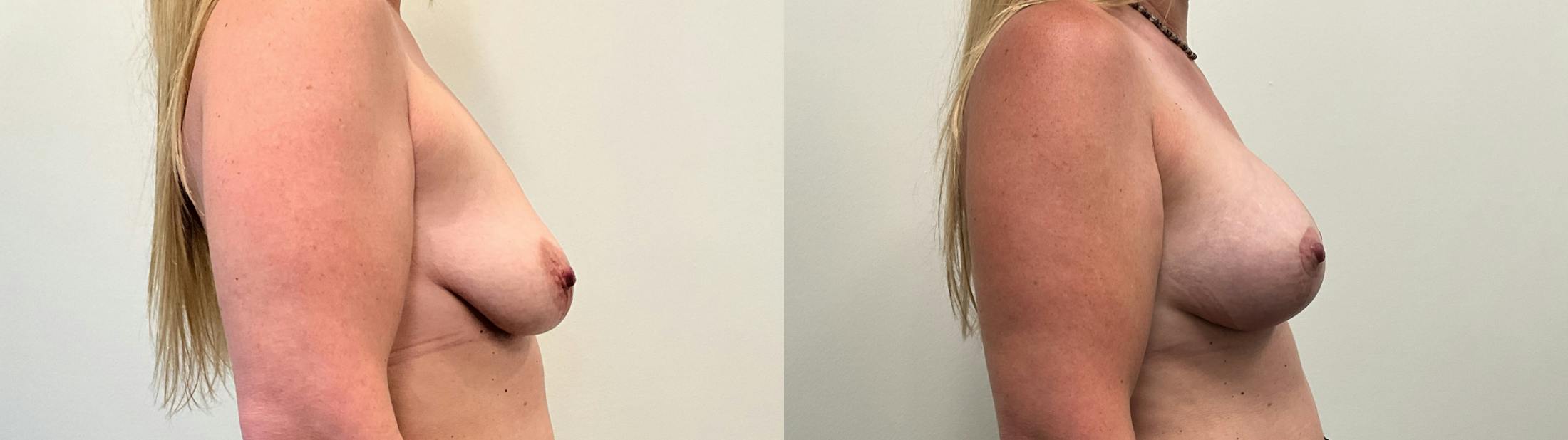 Breast Augmentation Before & After Gallery - Patient 298044 - Image 3