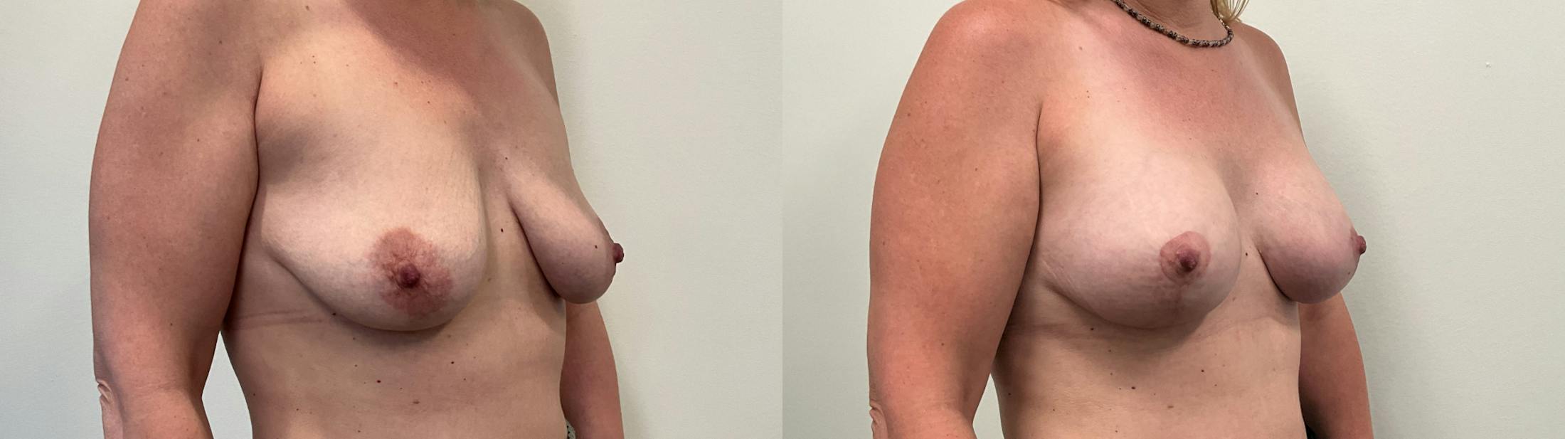 Breast Augmentation Before & After Gallery - Patient 298044 - Image 4