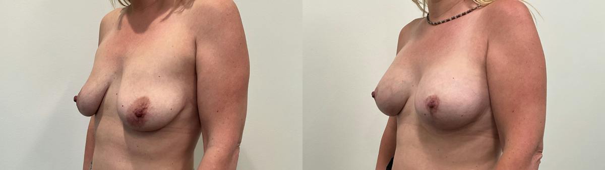 Breast Augmentation Before & After Gallery - Patient 298044 - Image 5