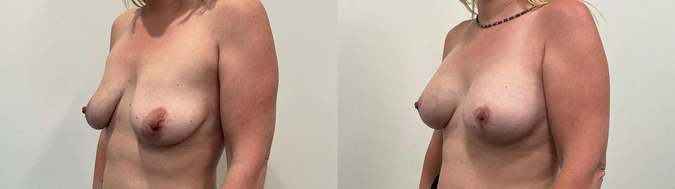 Breast Augmentation Before & After Gallery - Patient 298044 - Image 5