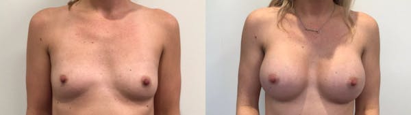 Breast Augmentation Before & After Gallery - Patient 159456 - Image 1